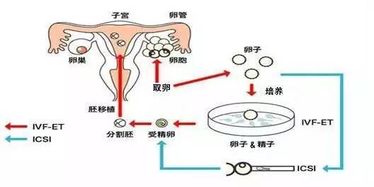 子宫内膜异位症